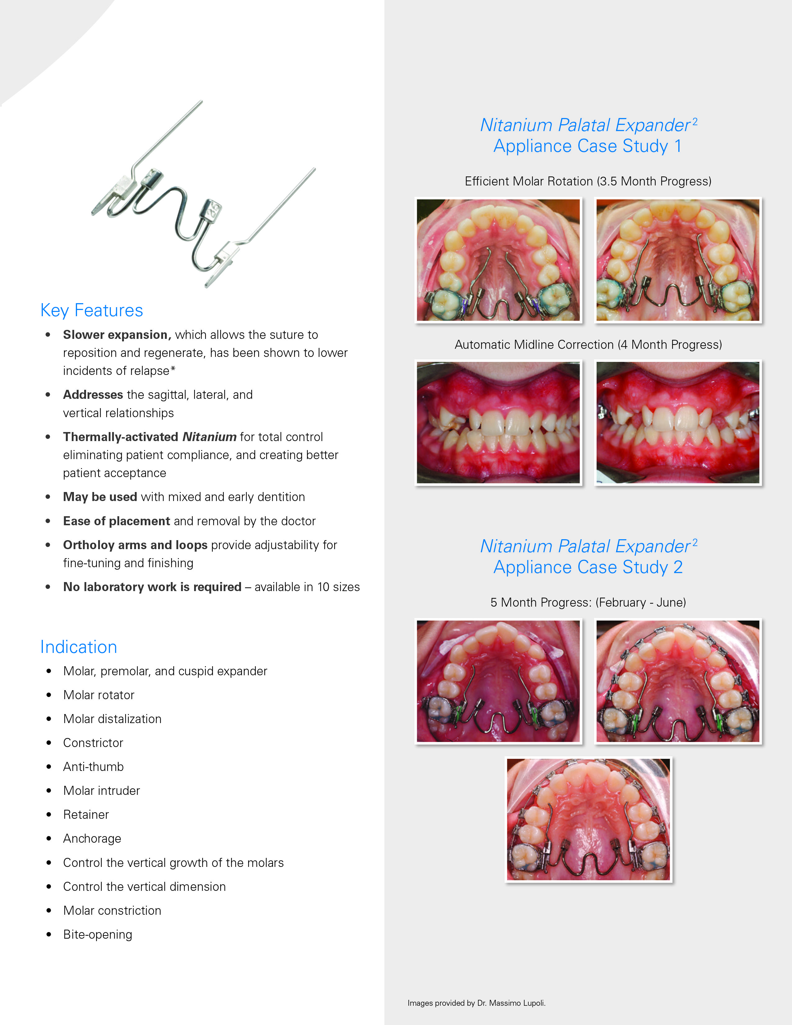 NITANIUM PALATAL EXPANDER 34MM NAOL Australia